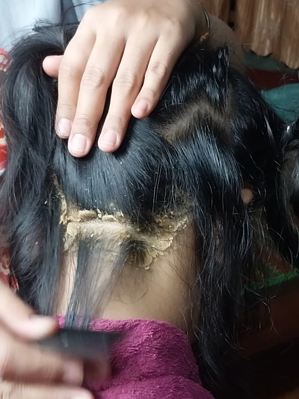 hard dandruff scratching hugeflake removal #GoodbyeDandruff #scalp #scratchingremoval #dandruffremoval #AntiDandruff #scalp 