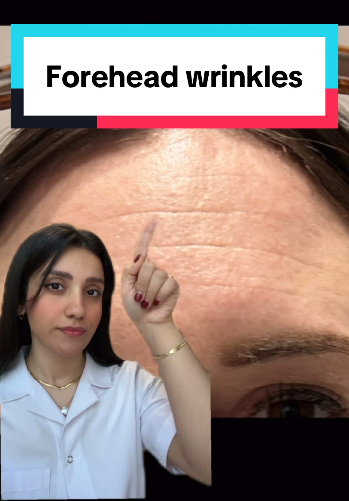 Forehead wrinkles? I’ve got you☺️ #wrinkles #fineline #antiaging #retinal #skincare 