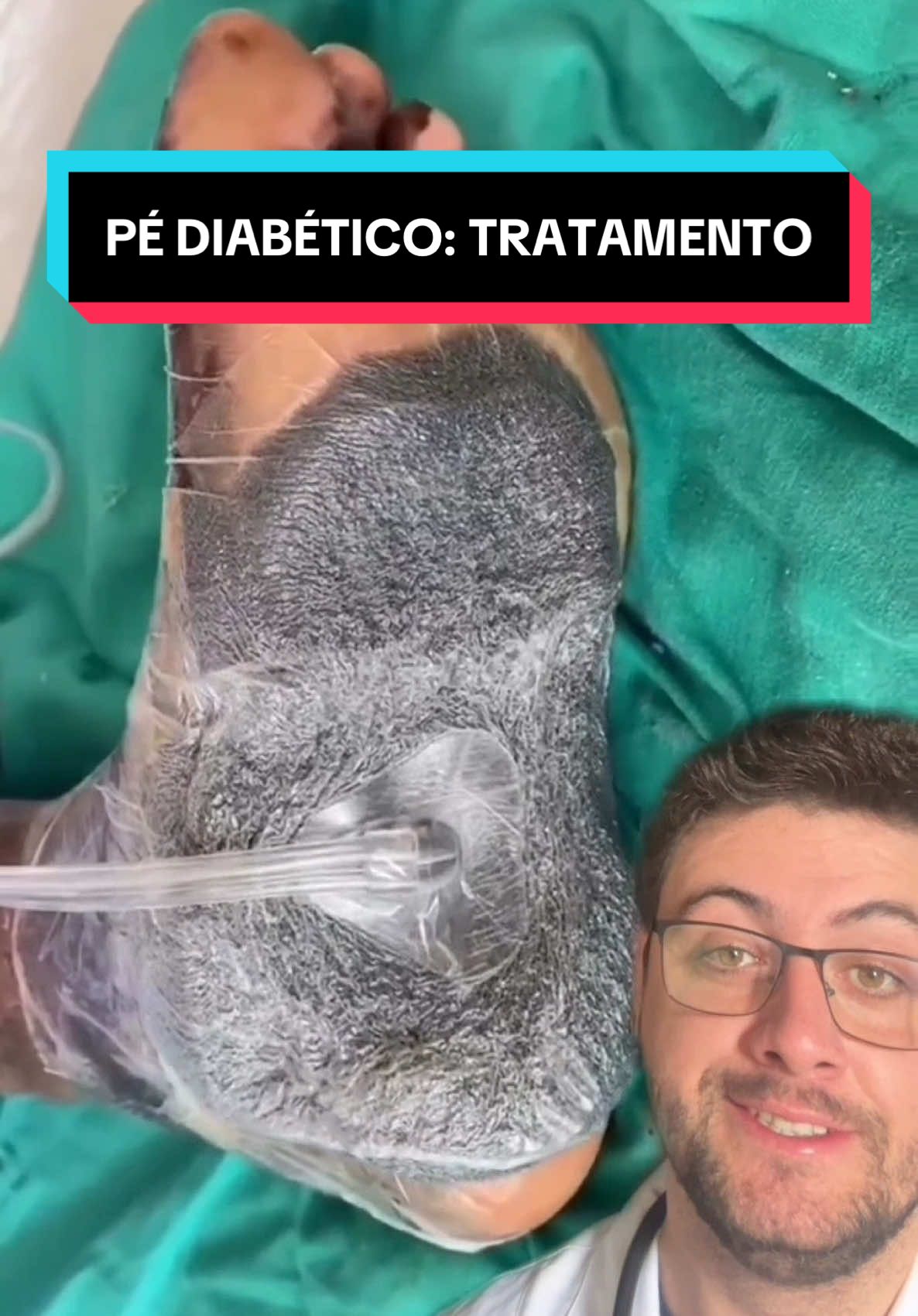 PÉ DIABÉTICO: TRATAMENTO #curiosidades #curiosidadesmedicas #diabetes #pediabetico #medico #medicina