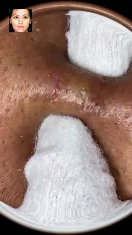 #squeeze #squeezeyuk #acne #pimple #pimplepop #blackhead #satisfyingvideos #fyp