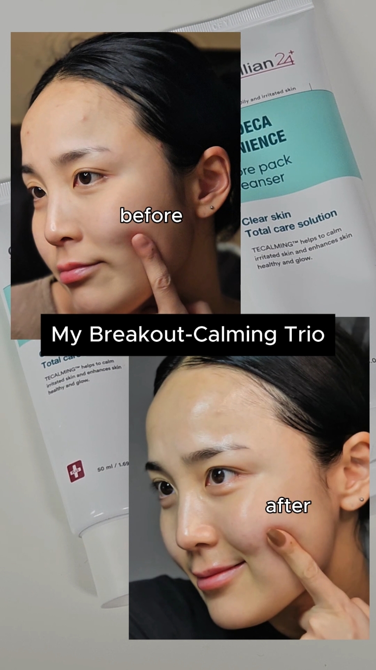 If you're struggling with breakouts, I highly recommend this trio from @Centellian24_global ! Centellian 24 was founded by Dongkook Pharmaceutical, a renowned company in Korea with 50 years of expertise. They're specialized in repairing damaged skin, so you know you're in good hands. I tried all three products from the Centellian 24 Madeca Acnience line, and they genuinely helped calm my sudden hormonal breakouts. Plus, I noticed an improvement in my post-acne pigmentation too! If breakouts are your concern, you have to give this a try! ✨ #skincare #koreanskincare #kbeautyskincare #koreancream #madecacream #centellian24 #centellacream #activeteca #MadecaAcnience #acnetreatment #acnejourney #acneprone #skincaretips  #skincaretips