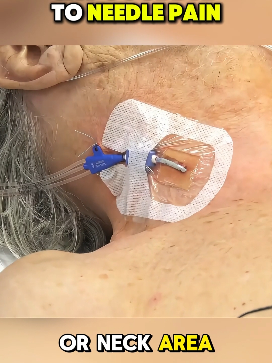 CVC Procedure 3d animation, central line for chemotherapy #medicalanimation #CVC #centralvenousline #cvcinsertion #medicaltip #CVCprocedure  #chemotherapy #centralline 