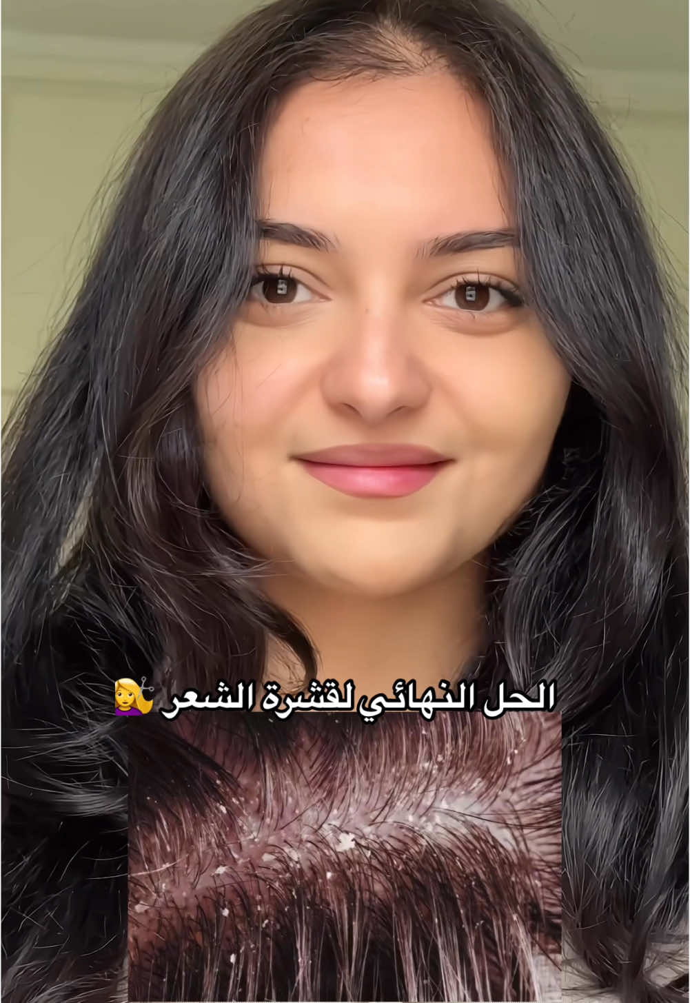 #عناية_بالبشرة #عناية_بالجسم #القشرة_في_الشعر #القشرة_في_الرأس #القشرة_الدهنية 