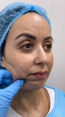 Rejuvenate Your Look with Thread Face Lift Say goodbye to sagging skin and hello to a more youthful, radiant appearance! Our Thread Face Lift procedure uses minimally invasive, absorbable threads to lift and tighten the skin, reducing fine lines and wrinkles. _Benefits:_ - Quick procedure with minimal downtime - Natural-looking results - Long-lasting effects - Customizable to address specific concerns _Target areas:_ - Facial sagging - Nasolabial folds - Marionette lines - Brow lift _Get ready to:_ - Restore your natural glow - Boost your confidence - Look and feel years younger Schedule your consultation today! #ThreadFaceLift #FaceLift #AntiAging #SkinRejuvenation #MinimallyInvasive #NaturalLookingResults #GlowUp #YouthfulAppearance #FacialRejuvenation #BeautyTreatment #CosmeticProcedure #cureme #cmc #curememedicalcomplex 