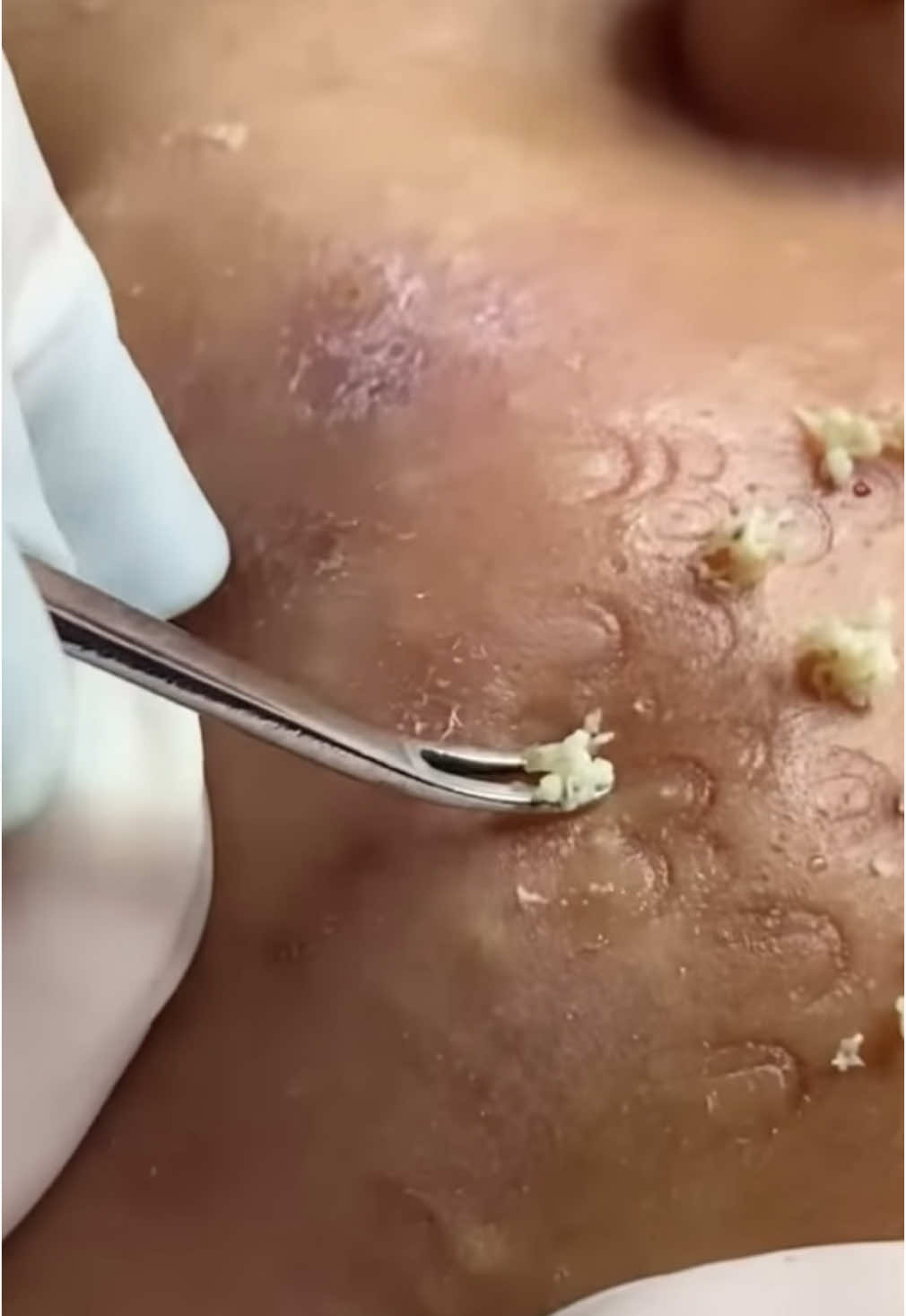 Check out this incredible tool in action as it effortlessly removes blackheads! 🌟Who needs a spa day? #SkincareRoutine #dermatologist #4you #viral_video #fyp #satisfyingvideo #squeeze #explore #squeeze #skinecare #tik_tok 