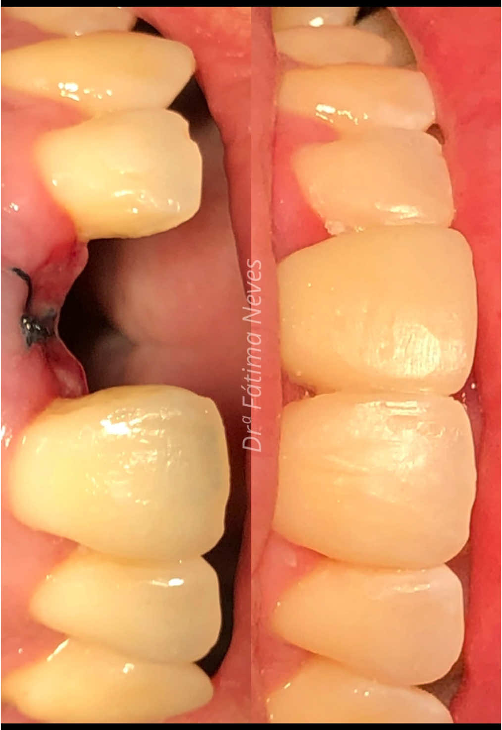 Mais um caso de PONTE FIXA EM FIBRA DE VIDRO E RESINA 🤩🖌️ #arte #odontologiaestetica #odontologiaespecializada #odontologia #pontefixa #dentista #dentistarj 