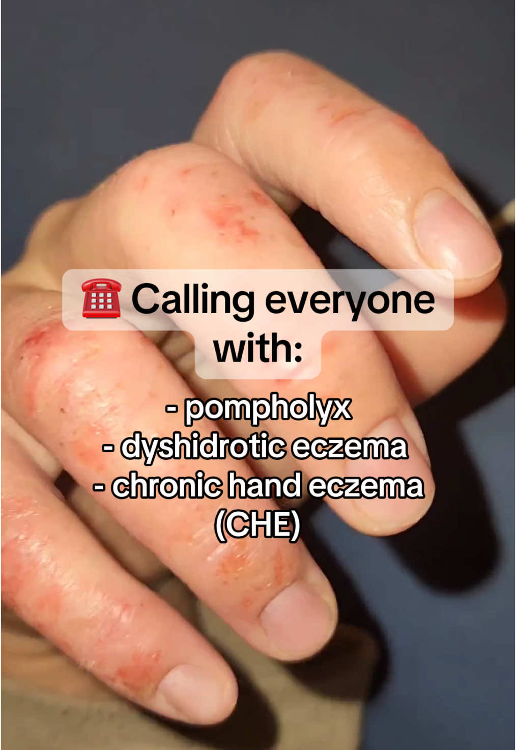 The BEST natural alternatives for eczema!! 🩵 #eczema  #eczemaawareness  #handeczema #chroniceczema #che #dyshidroticeczema #pompholyx 