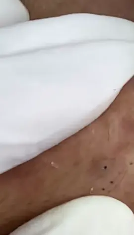Boa noite! Bom descanso💗 gostaram do vídeo?  #satisfyingvideo #popping #foryourepage #blackhead #pimplepop #CleanTok #acne  Ib: https://youtu.be/CiSHjqIpa-0?si=sNrqyr7JOqjtmcVA