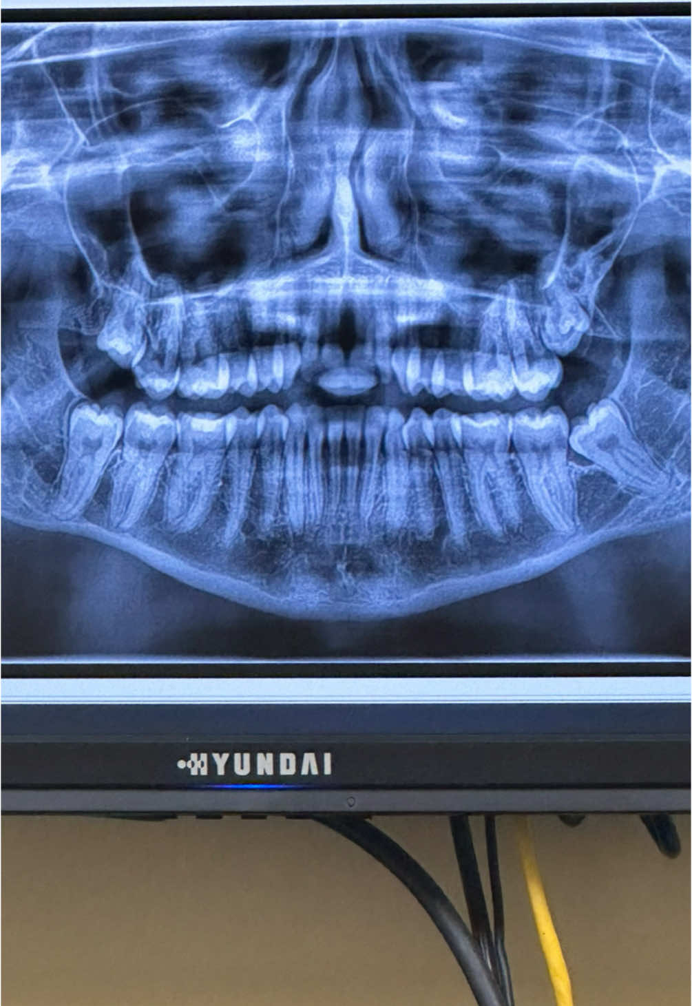 Anyone else have a complicated case like this? I need advice! How bad is the recovery?? #wisdomteeth #surgerytiktok 