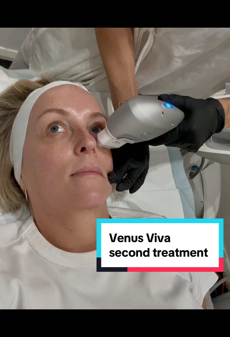 Back at @Base Aesthetic Clinic today in south Perth for the second session of my rejuvenating eye treatment. We are doing #venusviva  and #ultraformer #creatorsearchinsights #matureskin #mature #collagen #beauty #over40 #over50 