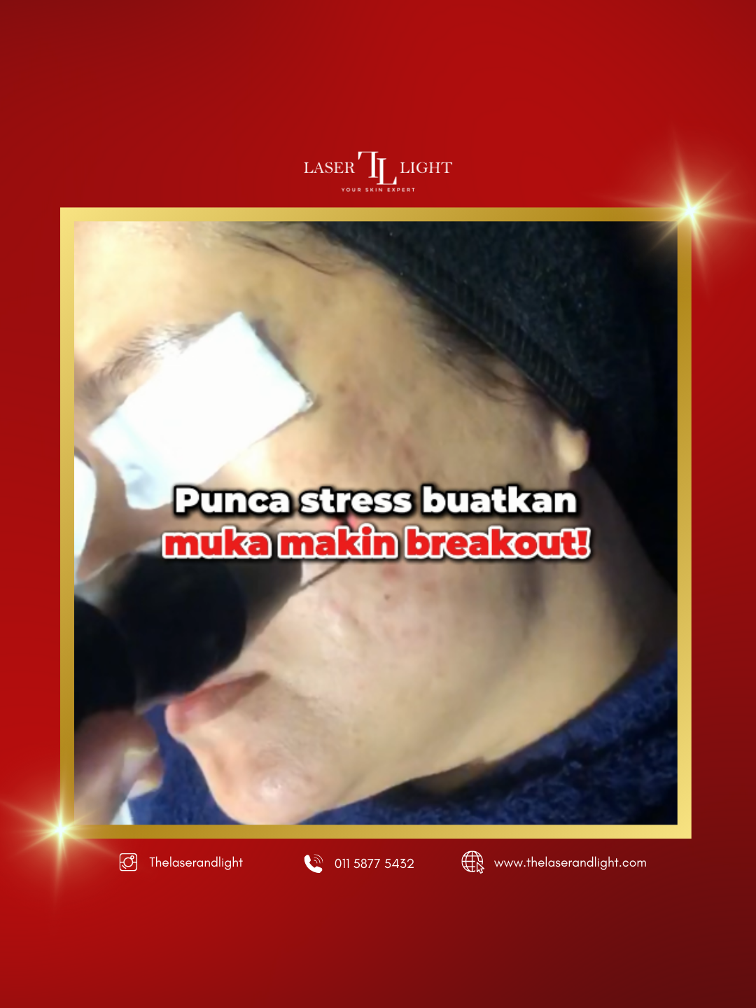 Punca stress buatkan muka makin breakout? Sampai parut jerawat pun makin banyak! Runsing betul bila jadi macam ni. Confident pun makin drop. Pakai skincare mahal pun tak boleh nak hilangkan parut jerawat ni! 😭 Jom cuba Rawatan Picowave ✨ Kami ada solusi untuk bantu hilangkan parut-parut dan jeragat muka. Jangan biarkan parut ganggu keyakinan, jom cuba rawatan kami hari ni! ✔️ Tidak Sakit⠀ ✔️ Tiada Downtime ✔️ Tiada Kesan Sampingan⠀⠀ Skin Centre:⠀⠀⠀⠀⠀⠀⠀⠀⠀⠀⠀⠀⠀⠀⠀⠀⠀⠀ 📍 branch Wangsa Maju⠀⠀⠀⠀⠀⠀⠀⠀⠀⠀⠀⠀ 📍 branch Cheras Permaisuri⠀⠀⠀⠀⠀⠀⠀⠀⠀⠀⠀⠀⠀⠀⠀⠀⠀⠀ 📍 branch Shah Alam⠀⠀⠀⠀⠀⠀⠀⠀⠀⠀⠀⠀⠀⠀⠀⠀⠀⠀ 📍 branch Bangi Sentral 📍 branch Ipoh Greentown⠀ 📍 branch Johor Bahru⠀⠀ 📍 branch Seberang Perai⠀ 📍 branch Kota Bharu⠀⠀ 📍 branch Kuantan⠀⠀⠀⠀⠀ ⠀⠀⠀⠀ (Laser & Light Holding Sdn Bhd)⠀⠀⠀⠀⠀⠀⠀⠀⠀⠀⠀⠀⠀⠀⠀ .⠀⠀⠀⠀⠀⠀⠀⠀⠀⠀⠀⠀ Join us at Telegram Channel to get more info & tips⠀ ⏩ https://t.me/laserlightskincentre .⠀⠀ Hubungi kami disini (Whatsapp):⠀⠀ ⏩ https://wa.me/601159602550 .⠀⠀ Website:⠀⠀ ⏩ https://www.thelaserandlight.com/⠀⠀⠀⠀⠀⠀⠀⠀⠀⠀⠀⠀⠀⠀⠀⠀⠀⠀⠀⠀⠀⠀⠀⠀ .⠀⠀⠀⠀⠀⠀⠀⠀⠀⠀⠀⠀⠀⠀⠀⠀⠀ #skincentre #laserlightskincentre #legscar #legscartreatment #skintreatment #aft #advancedfluorescenttechnology #darkunderarm #promo #darkknee #darkspot #beauty #skincare #wangsamaju #wangsawalk #shahalam #aestheticcentre #hairremoval #lighttherapy #aestheticmalaysia #skinhealth #pigment #acne #scar #ultimatefacial #facial