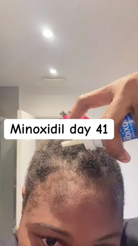 #minoxidil #results #hairtransplant #hairloss #viral 