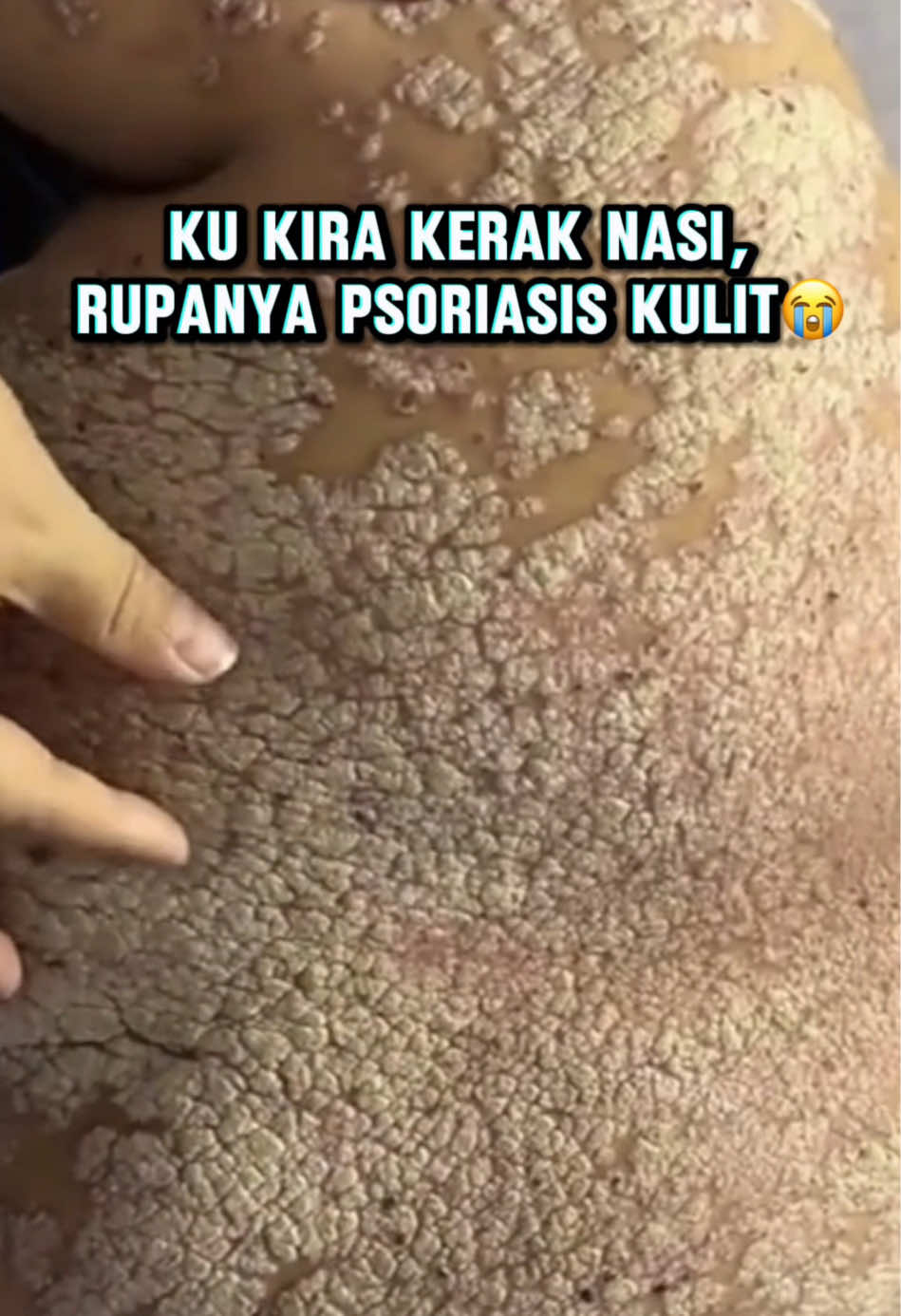 #minyakgeronggang #gatal #gatalgatal #gatalalergi #gatalgigitanserangga #infeksi #penyakitkulit #obatherbal #panu #kadas #obat #kurap #eksim #luka #kutuair #jerawat #dermatitis #biduran #psoriasis #jamuran #arbaplus #obatgatal #rekomendasidokter #fyp #viral #foryou #populer #beranda #trending