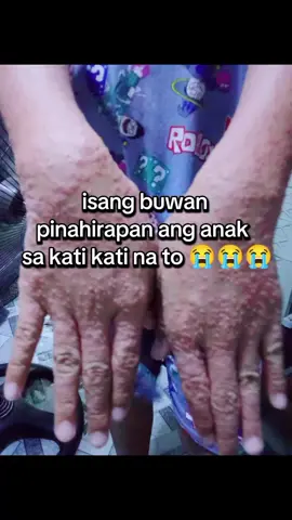Legit cream na ngpapagaling kahit anong kati kati sa balat nyo FDA approved 👌🏻☺️✨#skinallergy #dermatitis #skinitch #skinfighter #ointment #solution #remedy #fyp #fypシ #fypシ゚viral #foryoupage #tiktok 