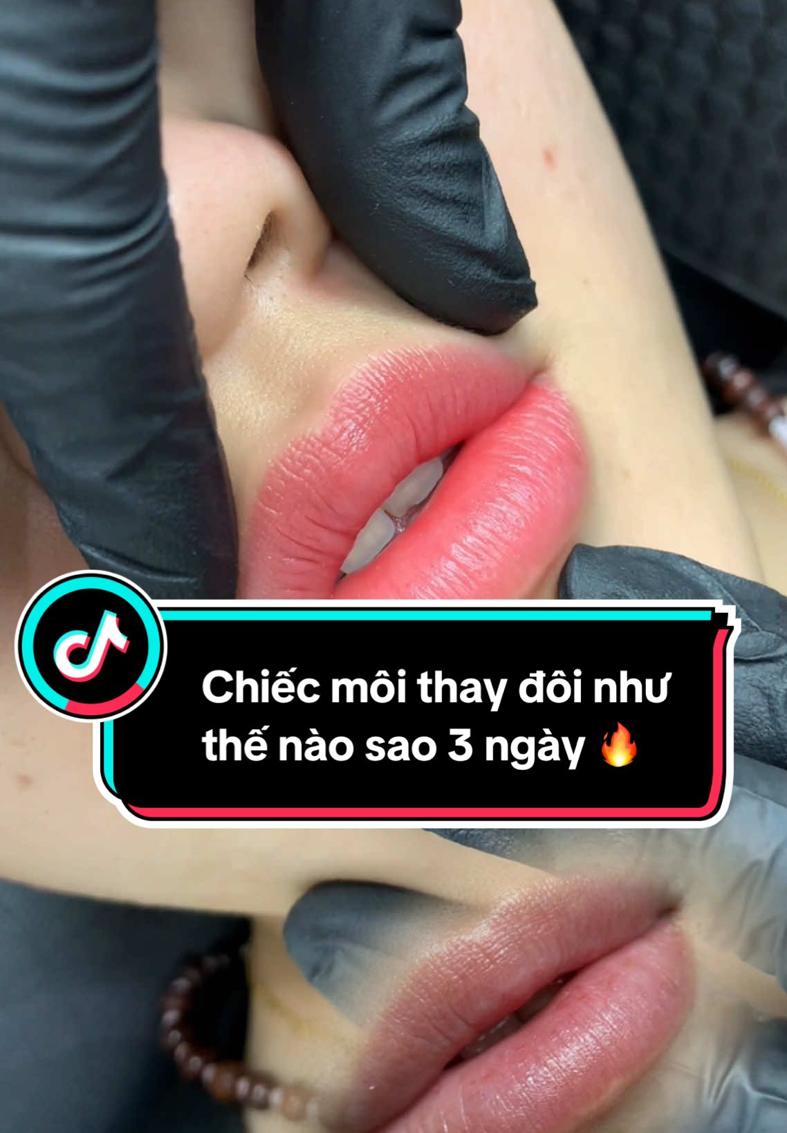 Chiếc môi đã thay đổi như thế nào sao 3 ngày 🔥 #fyp #xuhuong #môi #phunmoi #