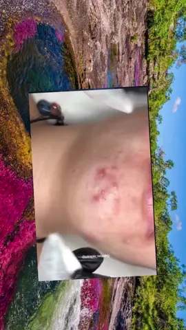 #squeeze #squeezeyuk #acne #pimple #pimplepop #blackhead #satisfyingvideos #fyp