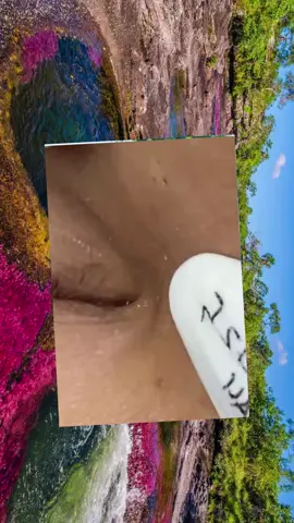 #squeeze #squeezeyuk #acne #pimple #pimplepop #blackhead #satisfyingvideos #fyp