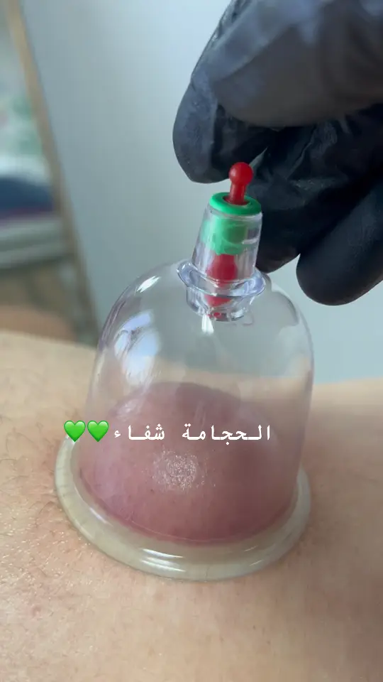 #الحجامة #cupping #cuppingtherapy #cuppingtherapy #الحجامة_النبوية #الحجامة_العلاجية #الحجامة_النبوية #فلسطين🇵🇸الاردن🇯🇴سوريا🇸🇾العراق #ليبيا🇱🇾 #تونس🇹🇳 #الجزائر🇩🇿 #fyppppppppppppppppppppp #الشعب_الصيني_ماله_حل😂😂🙋🏻‍♂️‍‍ #الجزائر🇩🇿 #fyppppppppppppppppppppp #اميرةالتريكي #الحجامة_شفاء #