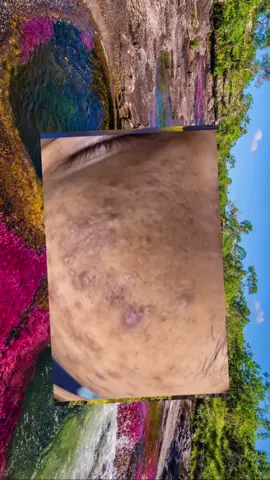 #acne #pimple #pimples #pimplepop #satisfyingvideo #pimplepopper #fyp
