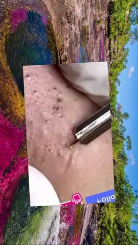 #acne #pimple #pimples #pimplepop #satisfyingvideo #pimplepopper #fyp