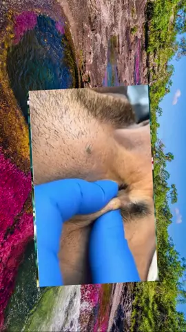 #acne #pimple #pimples #pimplepop #satisfyingvideo #pimplepopper #fyp