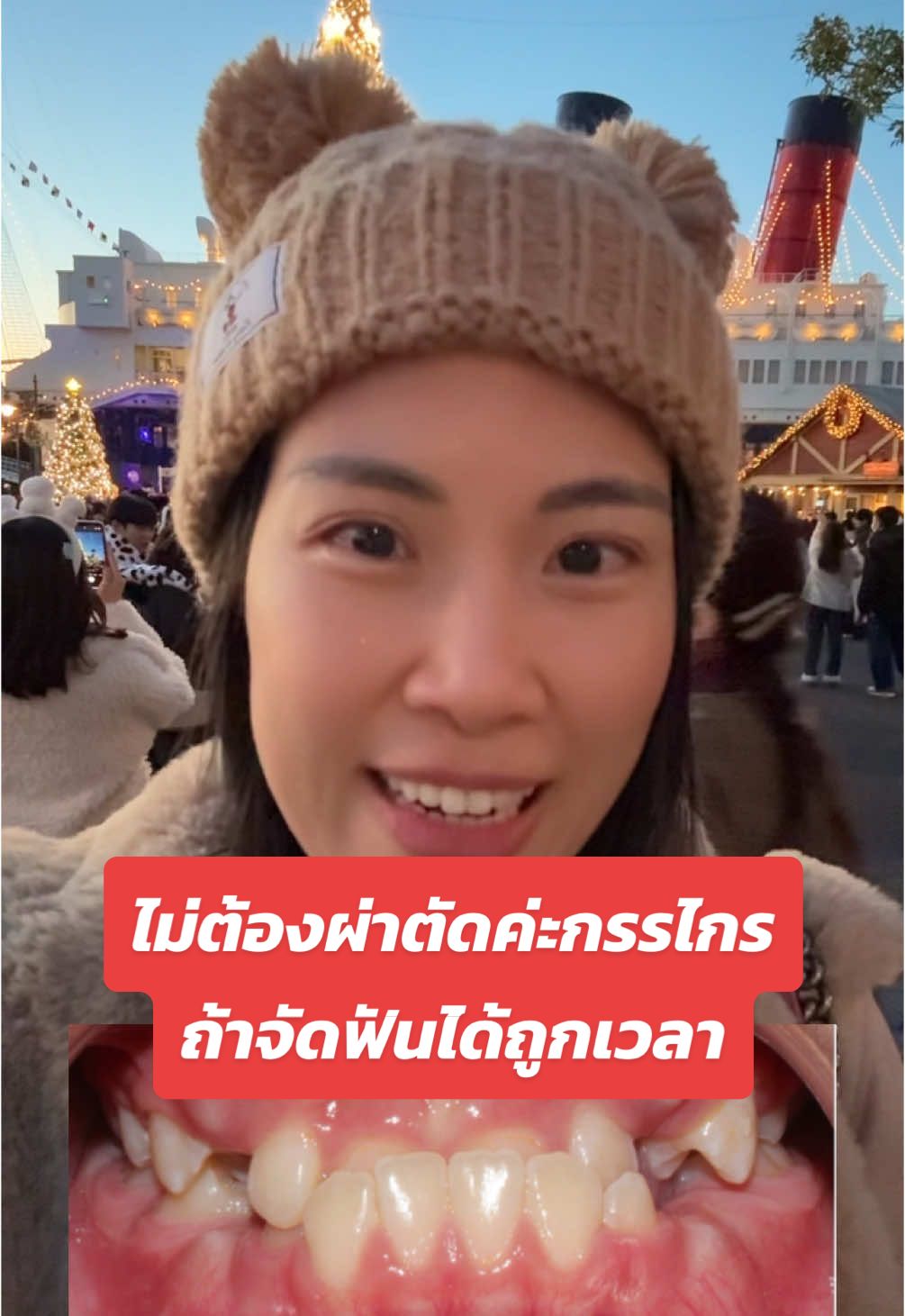 ไม่ต้องผ่าตัดค่ะกรรไกร ถ้าจัดฟันได้ถูกเวลา #จัดฟัน  #จัดฟันพระราม3 #จัดฟันครั้งแรก #สียางจัดฟัน  #tinysmiledental #จัดฟันครั้งแรก #รีวิวจัดฟันใส #จัดฟันใส #จัดฟันเปลี่ยนชีวิต  #หมอเอมมี่tinysmile #จัดฟันโดยแพทย์เฉพาะทาง  