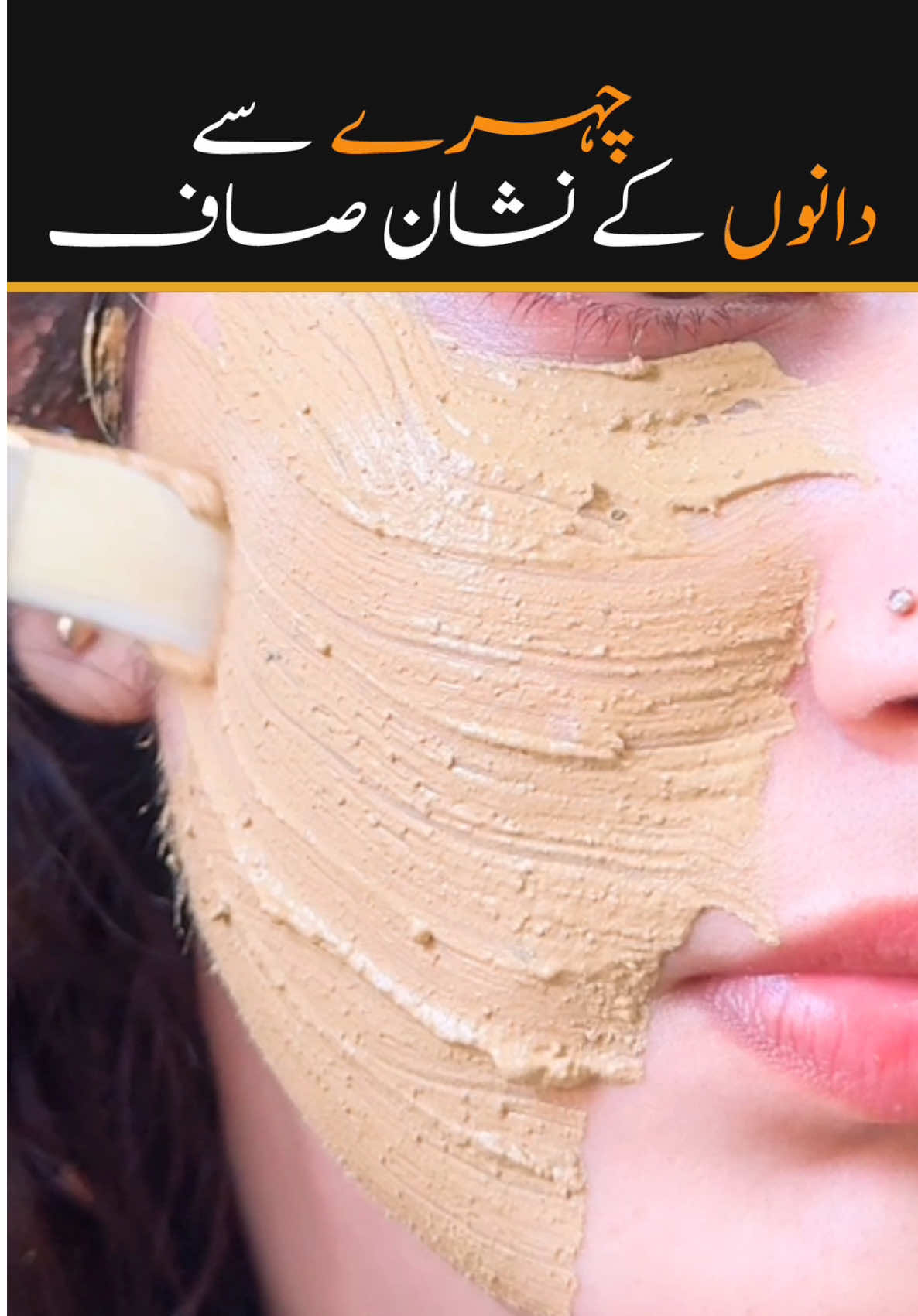 Acne skin treatment #skincare #acnetreatments #skinglow #faceglow #shumailasdiary 