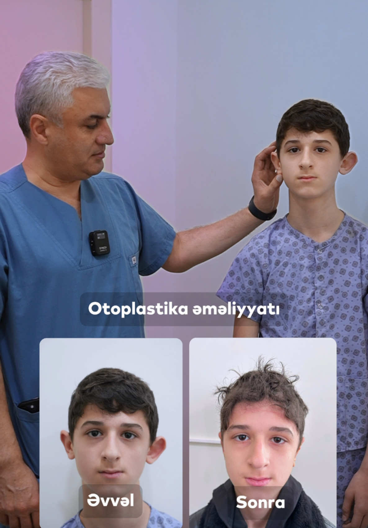 Otoplastika əməliyyatı ✅ 25 illik TƏCRÜBƏ…  ⬇️ Qeydiyyat və konsultasiya üçün: ⬇️ For appointment and consultation: ⬇️ Для записи и консультации: 📞 +994555880909 Əməliyyatlar ilə bağlı daha ətraflı məlumat üçün əlaqə saxlayın! ⬇️ 📲 | 055 588 09 09 📍 | Ünvan: Binəqədi r-nu, M.Ə.Rəsulzadə qəs, M.Davudoğlu küç.12 A 🏥 | Vimay Medical Center #drmüşfiqqasimov #abdominoplastika #qaringermeemeliyyati #liposaksiyabaku #estetikcerrahi #rinoplastika #temporallift 