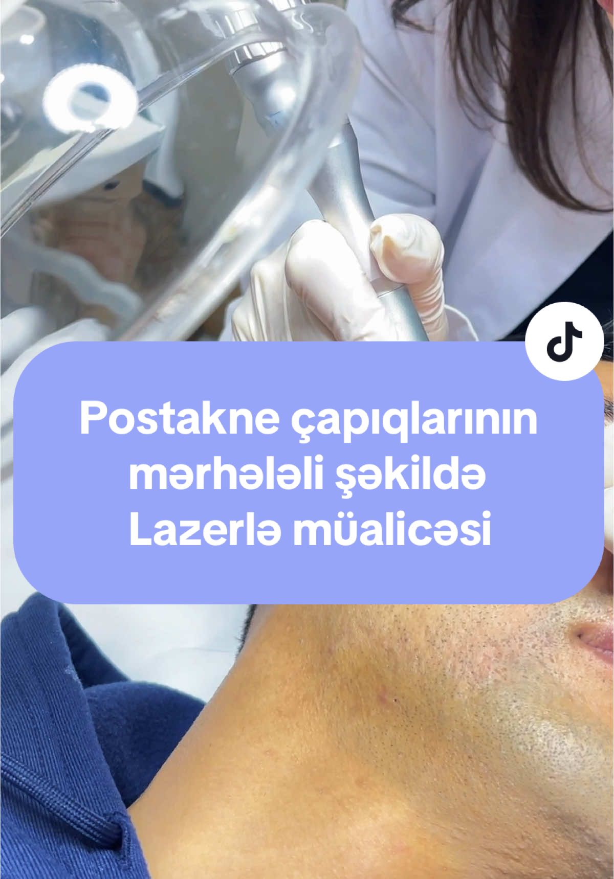 Həkim, Dermatoloq-Kosmetoloq Dr.Gülşən Əzizova #çapıq #çapıqlarınmüalicəsi #çapıqlarınlazerlemüalicəsi #çapıqlarınlazerləmüalicəsi #çapıqlar #çapıqlarınmüalicesi #çapıqlarınlazerlemüalic #çapıqmüalicəsi #capiq #capiqmualucesi #capiqmualicesi #capiqlarinmualicesi #scar #scartreatment #scartreatments #scartreament #scarlasertreatment #scarlaserremoval #Scar Laser Treatment Parut Lekuk #scar #baki #azerbaycan #baku #azerbaijan #dermatologiya #kosmetologiya #dermatoloq #kosmetoloq #шрам #шрамы #шрамыналице #шрамналице #лечениешрамов #рубцы #лечениерубцов #дерматология #дерматолог #косметология #косметолог #баку #азербайджан #врекомендации #keşfet #fyp #postaknescars #postakne #postakneçapiqlar 