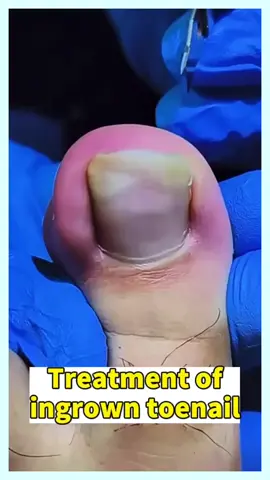 #ingrowntoenailremoval #tiktokchallenge #foryou #viralvideo #thisis4u #ingrowntoenail #nails #toenails #pedicure