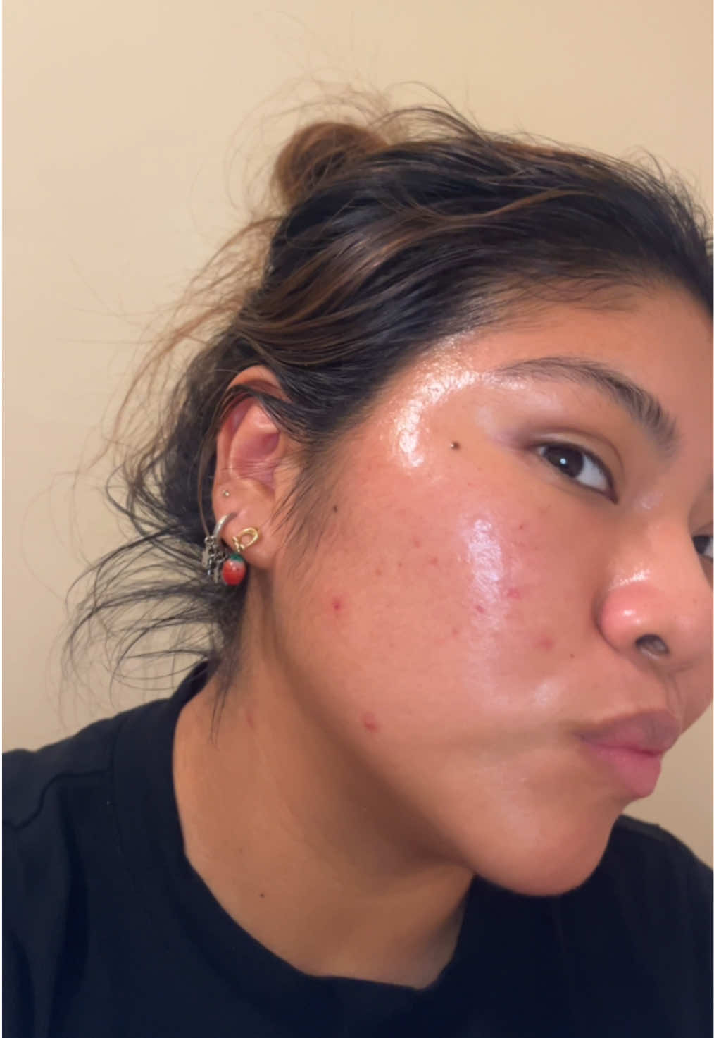 That post peel GLOW!!! I know my skin looks crazyyyy but just wait ✋🏽 #biorepeel #biorepeelblue #chemicalpeel #hyperpigmentationtreatment #acneproneskin 