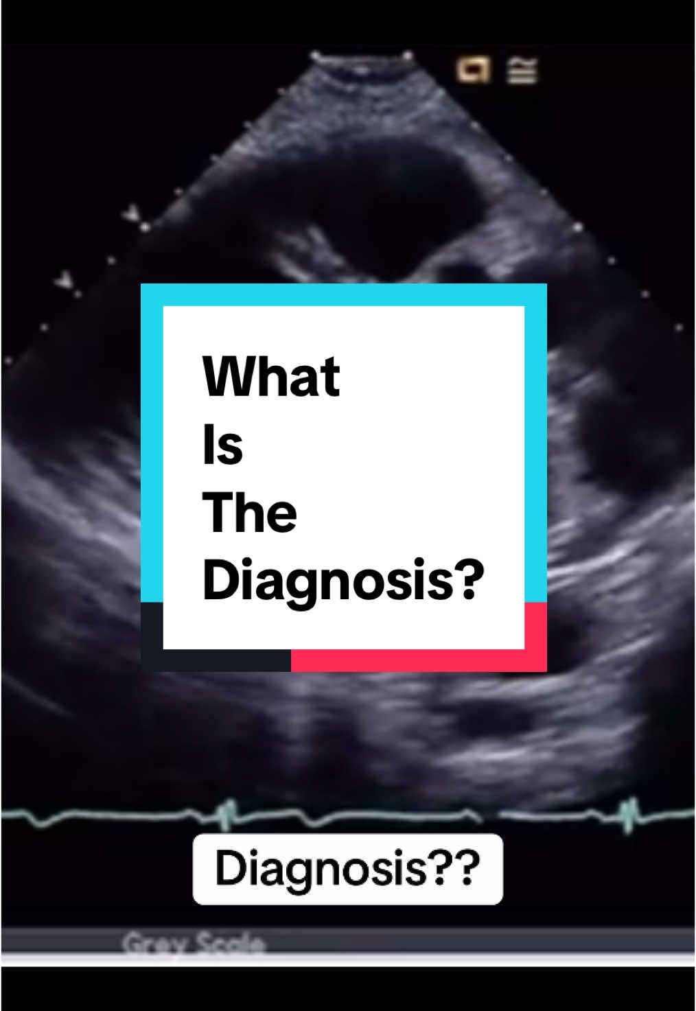 #echocardiography #cardiacsonography #cardiacsonographer #cardiacsonographystudent #whatisthediagnosis #cardiac #diagnosis #nurse #sonography #sonographystudent #sonographer 