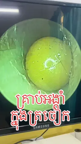 #មន្ទីរពេទ្យបង្អែកពោធិ៍ចិនតុង #Telegram089590007 #ត្រចៀក #ច្រមុះ #បំពង់ក #fyp #vrial 