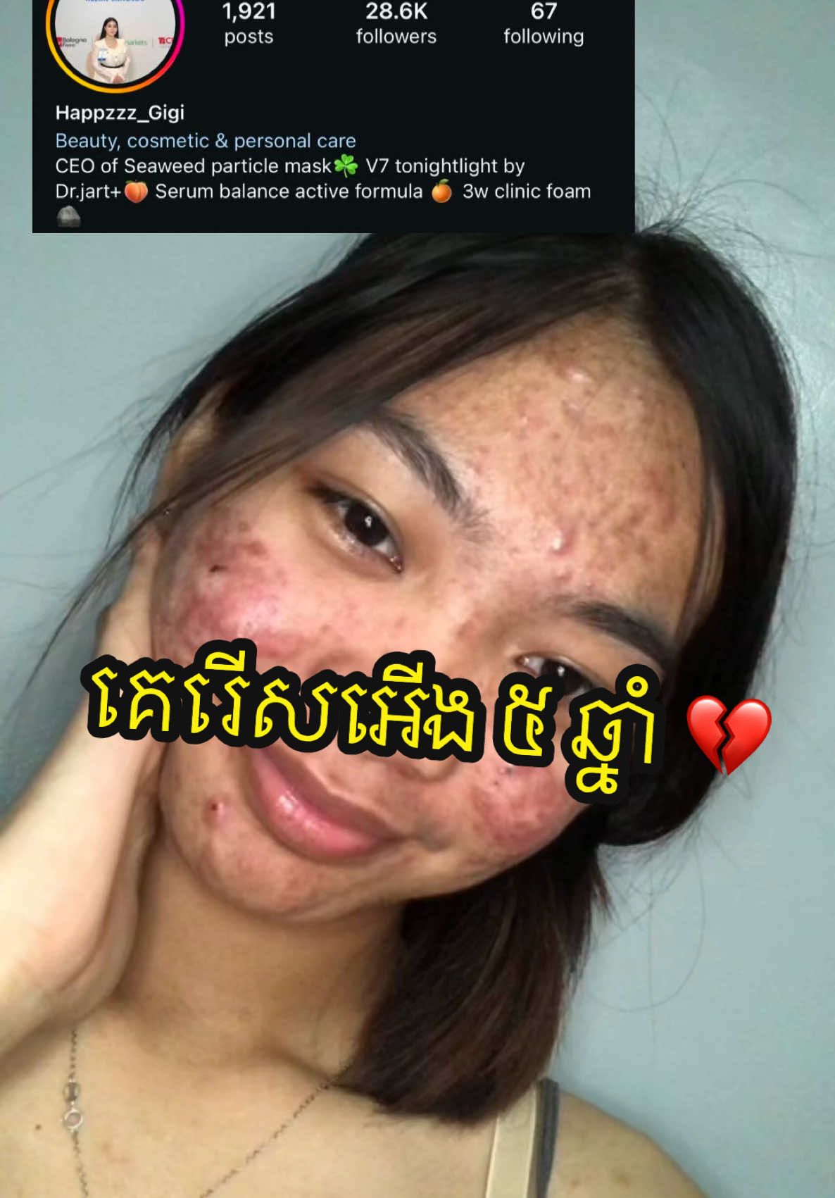 💔កើតមុនរយៈពេល ៥ ឆ្នាំ មិនមែនរឿងធម្មតាណា បងប្អូន 💔🔥 ទៅណាមកណា គេសម្លឹងមុខយើងបែបឆ្ងល់ម៉ង 😨💔 #sokkakka ✨ #happizy_gigiii #kakka_beautylab  #naogenspottreatment #spottrestment #truebrandshop ❤️ #tbscosmetic  #skincareroutine #clearskin #UGC