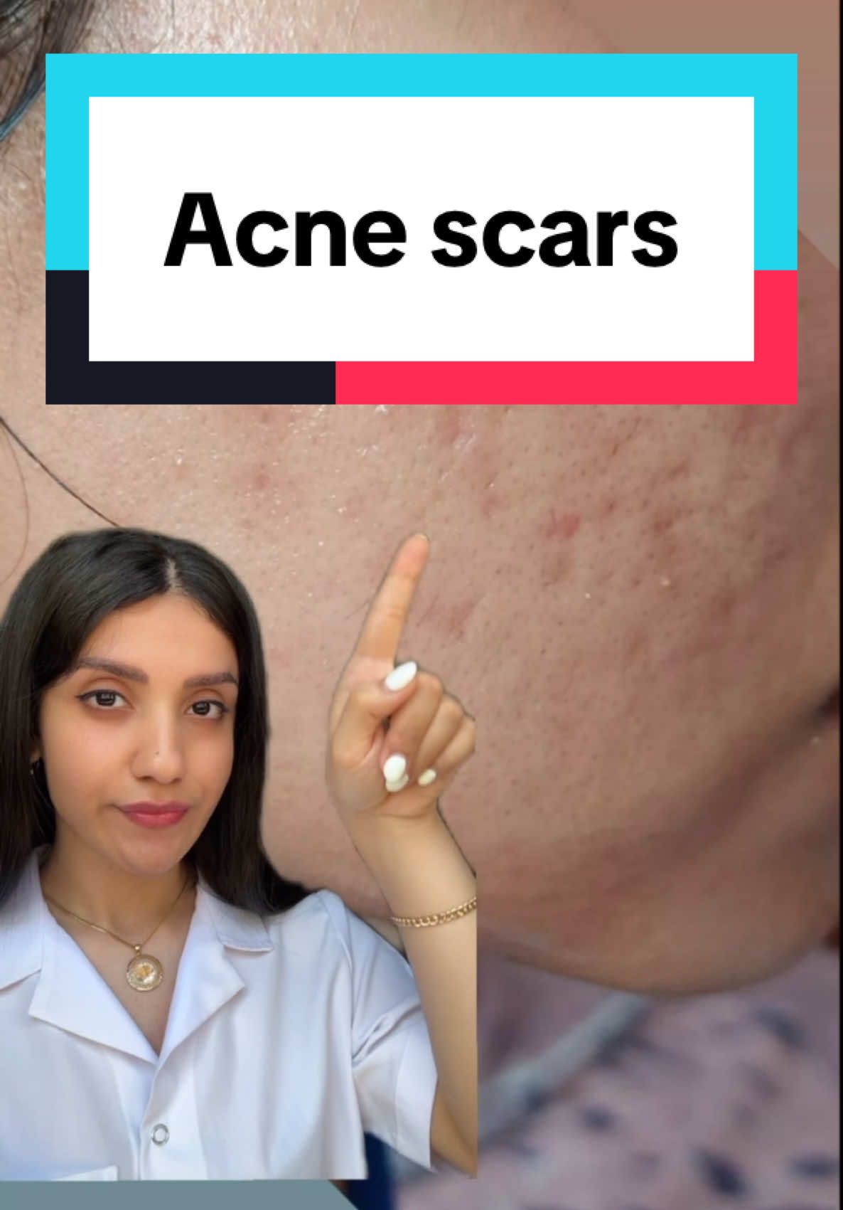 Tretinoin can significantly improve the appearance of acne scars over time by promoting collagen production and enhancing skin texture. However, results are gradual and best for mild to moderate scars. For deeper scars, combine tretinoin with professional treatments like microneedling or lasers for optimal results. Patience and consistent use are key to achieving smoother skin. #acnescars #acnemarks #scar #tretinoin #skincare 