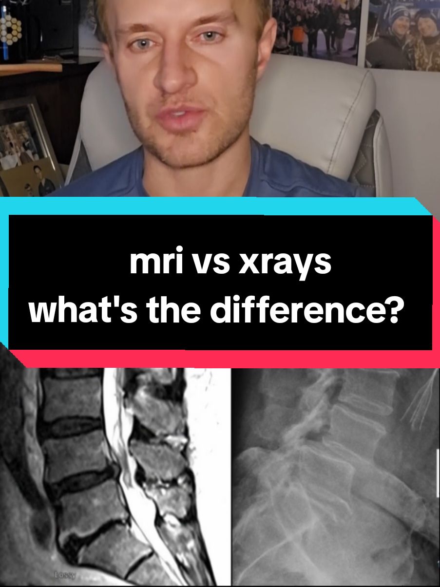 spinal instability and spondylolisthesis explained using mri and xrays, treated with fusion (lateral interbody or XLIF surgery) #spondylolisthesis #spinalinstability #spinalfusion #neurosurgery #spinesurgery #orthopedicsurgery #spinefusion 