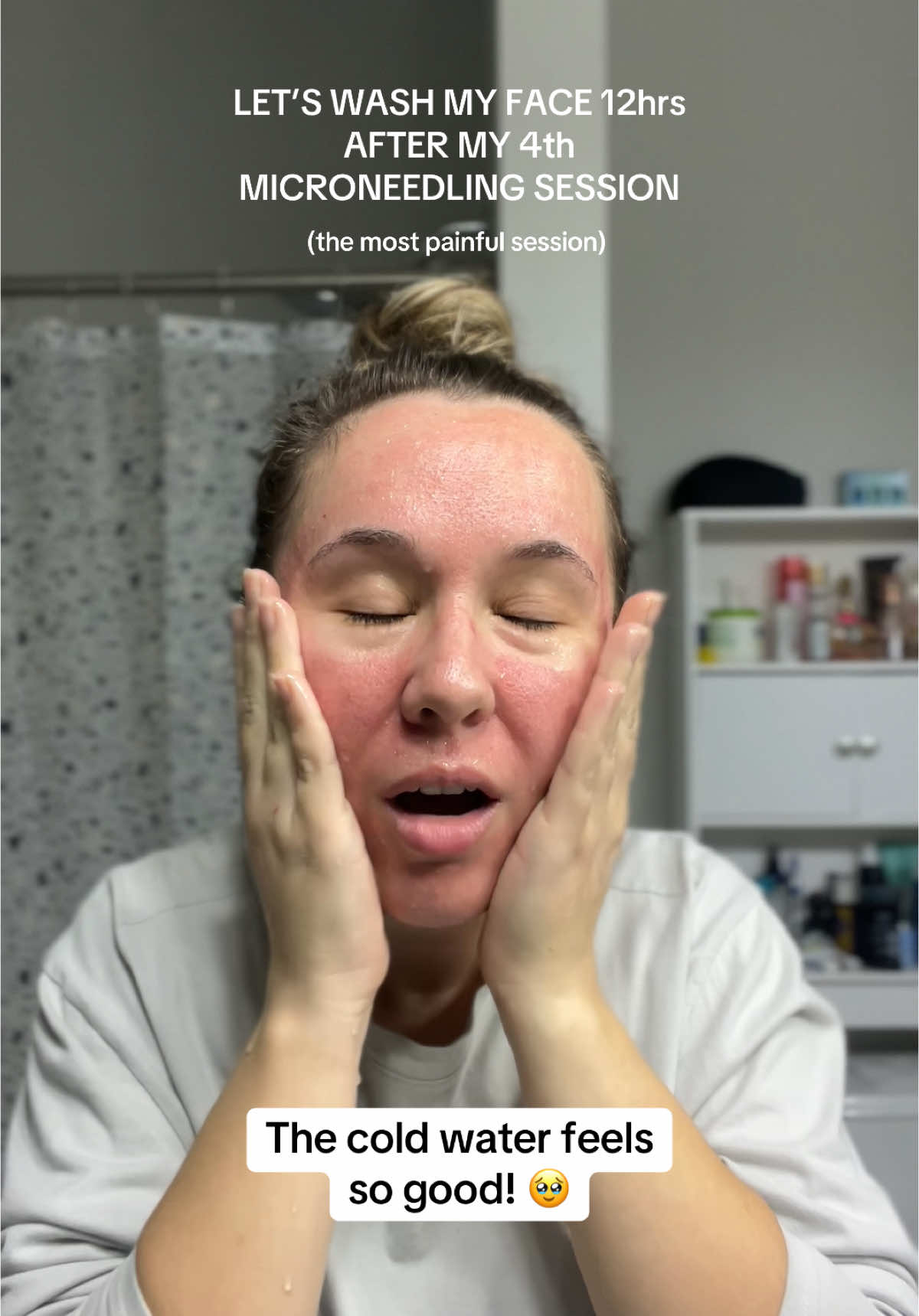 Let’s wash my face 12hrs after my 4th microneedling session. This was the most painful session out of all of them so far. But we did it! 🥰 As always, using my favorite skincare products @EltaMD Skin Care 🥰 #skincare #skincareroutine #skincaretiktok #microneedling #microneedlingface #acneskin #acneproneskin #acnescars 