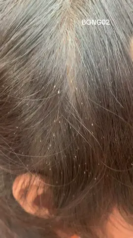 Oh, there are not many lice eggs😱#omg #lice #liceremoval #tiktokindia #satisfatorio #trending 