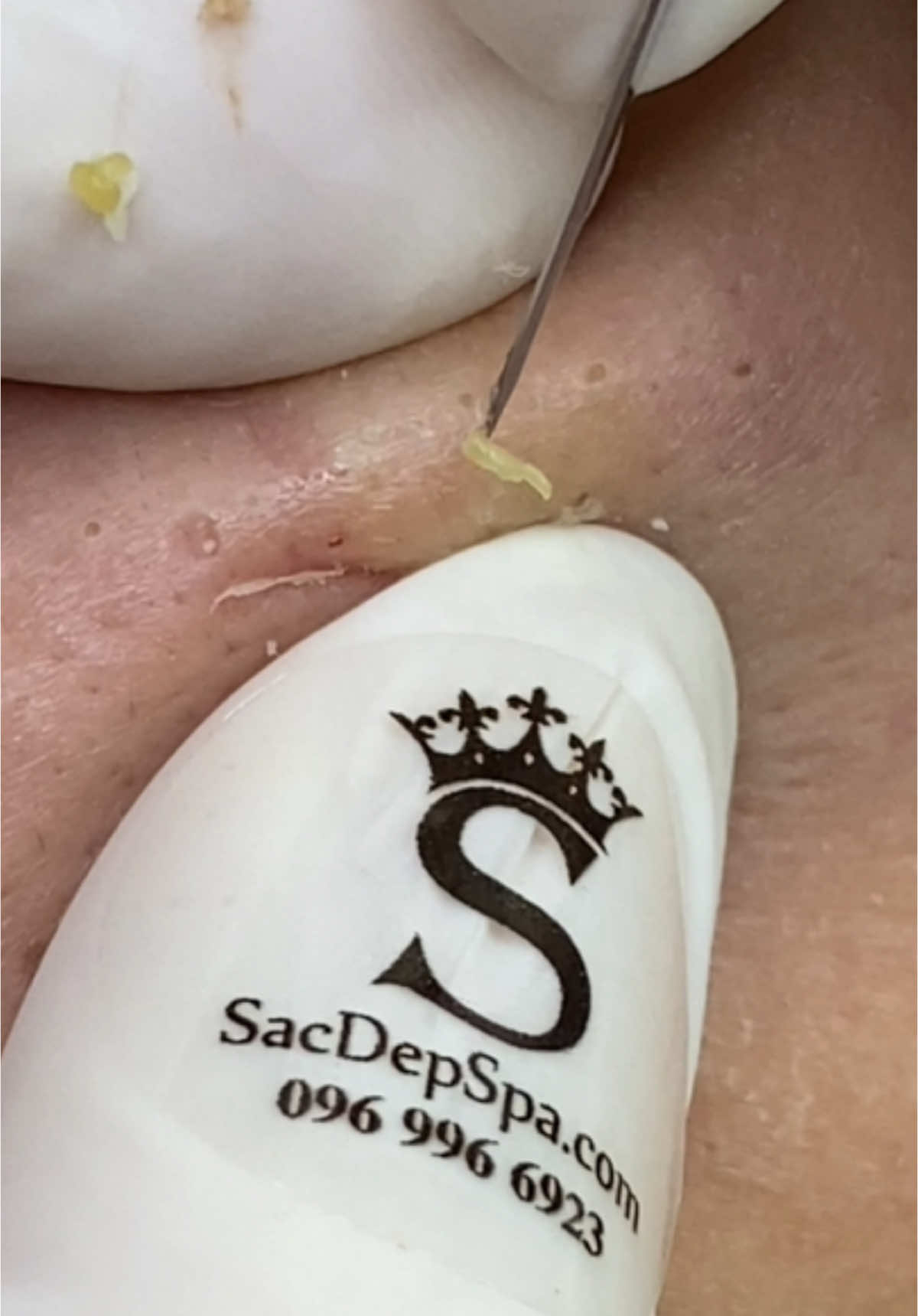 Ẩn sâu trên mặt #sacdepspa #relax #nặnmụn #làmđẹp #pimple 