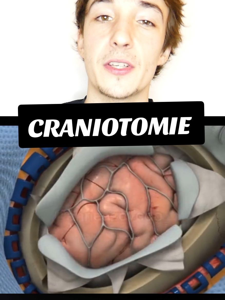 La craniotomie 🤯 #chirurgie #medecine #sante #france 