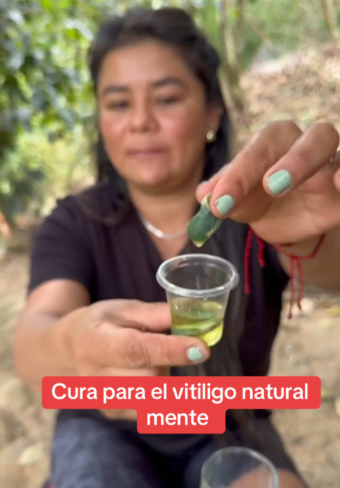 Cura el vitíligo naturalmente con la hiel de gallina de patio rápidamente