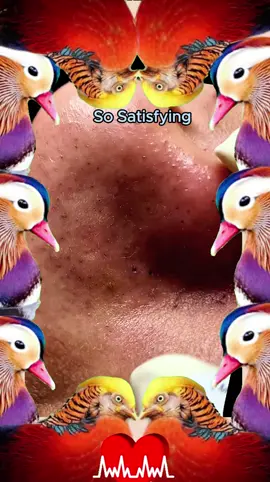 #squeezeyuk #satysfying #pimple #foryou #relax 