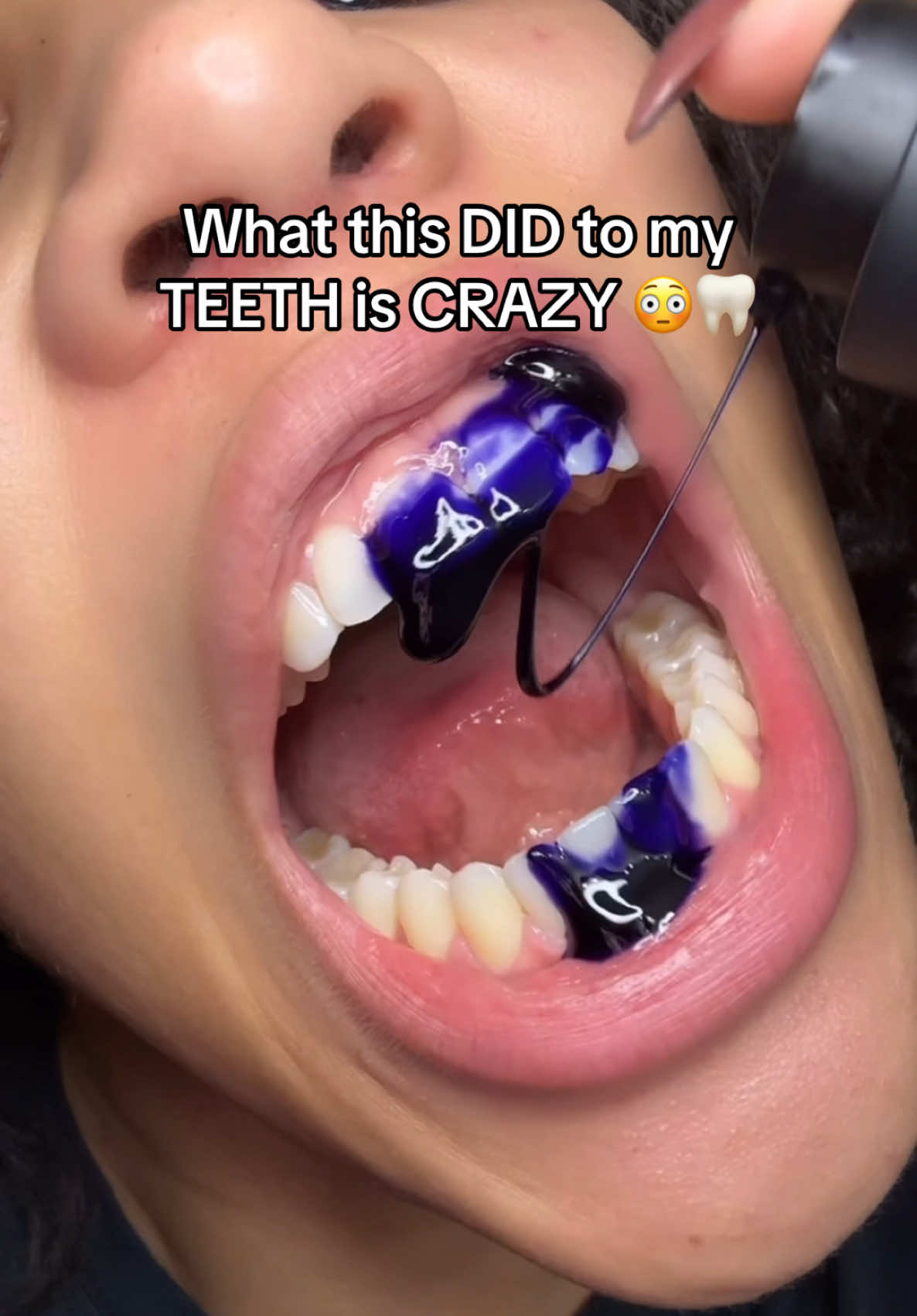 Holy shizzzz  #teethcare #teethwhitening #TikTokShop #tiktokshopholidaysale #tiktokshopfinds #whiteteeth #teethtok #oralhygiene #oralhealth #fy #fyppppppppppppppppppppppp 