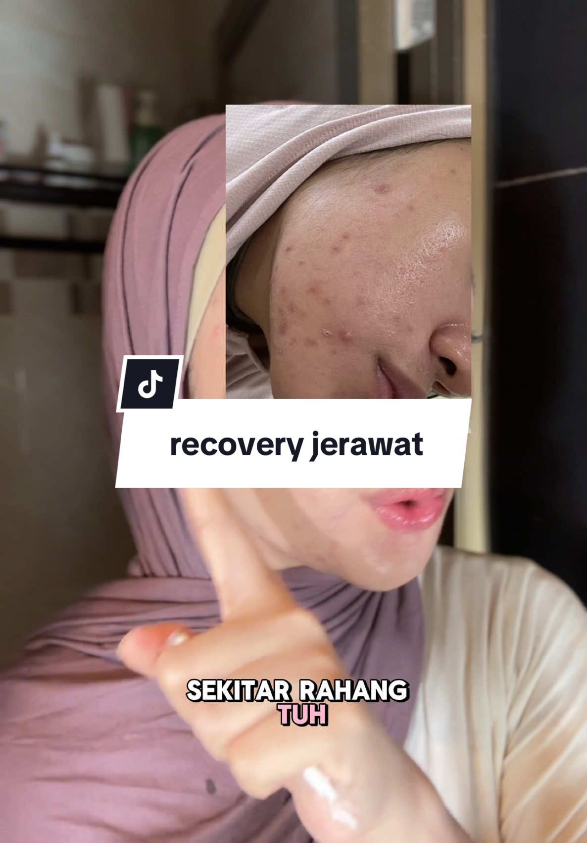 pake acne spot emg helpfull buat recovery jerawat nya! #drleo#drleoID#acne#AcneBuster#AcneSolution#acnetreatment#skincare#fyp#pimple