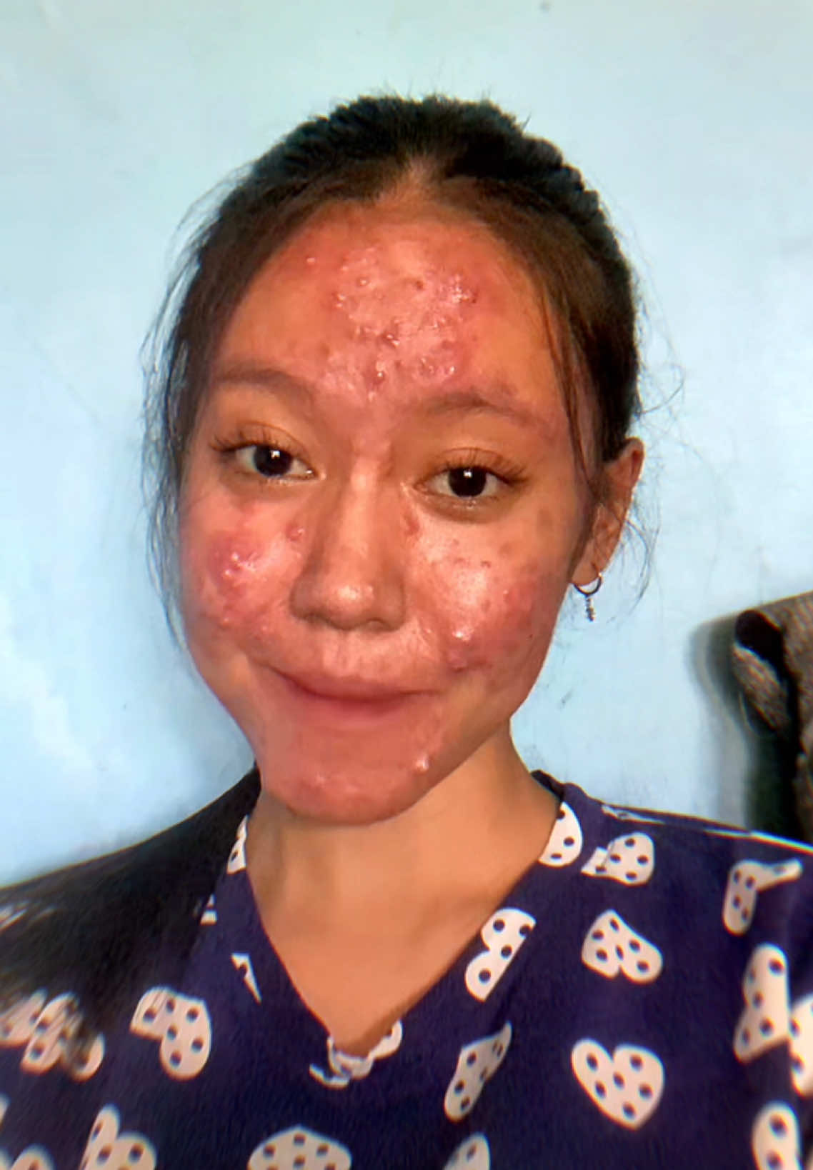 #fyp #acne #acnefighter #acneskin #GlowUp #xyzbcafypシ #xyzbca 