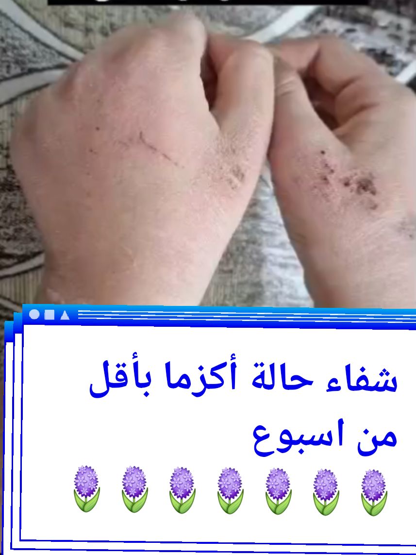 #شفاء #الاكزما #مالي_خلق_احط_هاشتاقات #الشعب_الصيني_ماله_حل😂😂 #millyon 