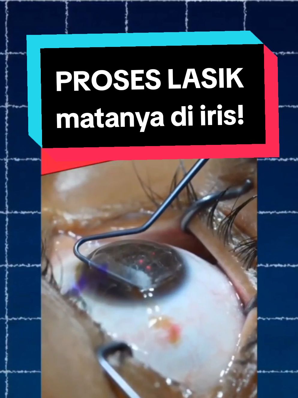 Inilah proses operasi LASIK supaya kamu gak perlu pakai kacamata lagi #lasik #mataminus #kacamata #operasi #operasimata