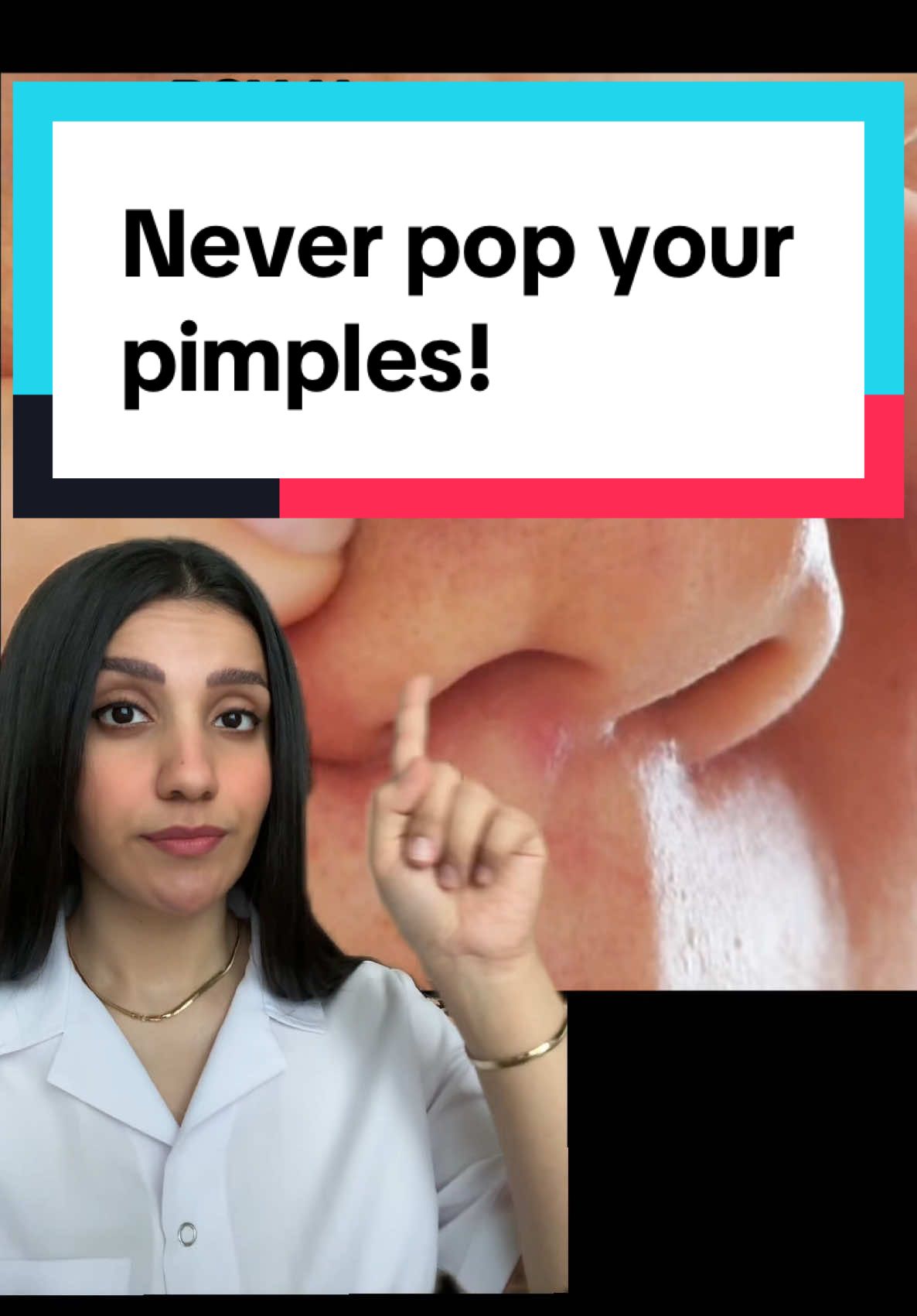 Popping pimples leads to acne scars, increases inflammation, and further breakouts. Instead, stick to Adapalene gel & Salicylic Acid for healthier, clearer skin. #acne #pimple #acnescar #acneskin #acnefighter 