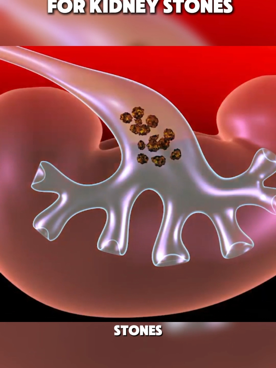 SHOCK WAVE LIYHOTRIPSY FOR KIDNEY STONES 3D Animation  #kidney #kidneystone  #KidneyStonesRemoval #LithotripsyProcedure #ShockWaveTreatment #KidneyHealth #StoneRemoval #MedicalBreakthrough #Urology #HealthyKidneys #KidneyStoneTreatment #NonInvasiveProcedure #medical3danimation #3dmedicalanimation 