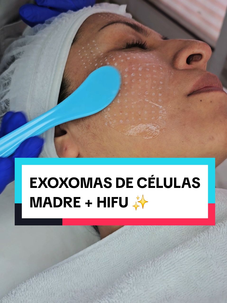 Amaras los resultados ✨️🥰 #exosomes #exoxomas #lapaz_bolivia🇧🇴 #tratamientosesteticofaciales #arrugasfaciales #lineasdeexpresion #lapaz_bolivia🇧🇴 #bolivia🇧🇴 